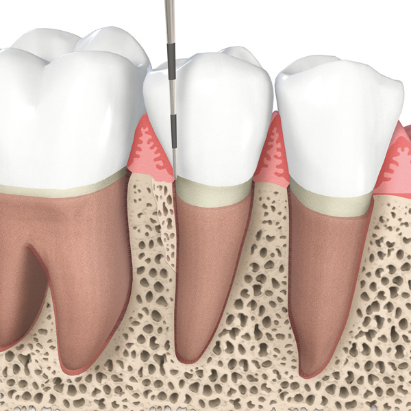 Ursache für eine Parodontitis sind Bakterien, die sich zwischen Zahn und Zahnfleisch ansammeln.