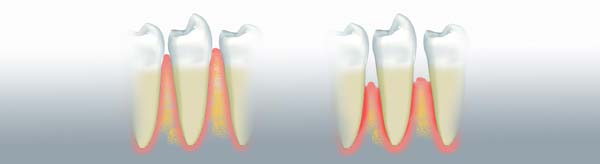 Çene kemiğinde diş implantı, şematik